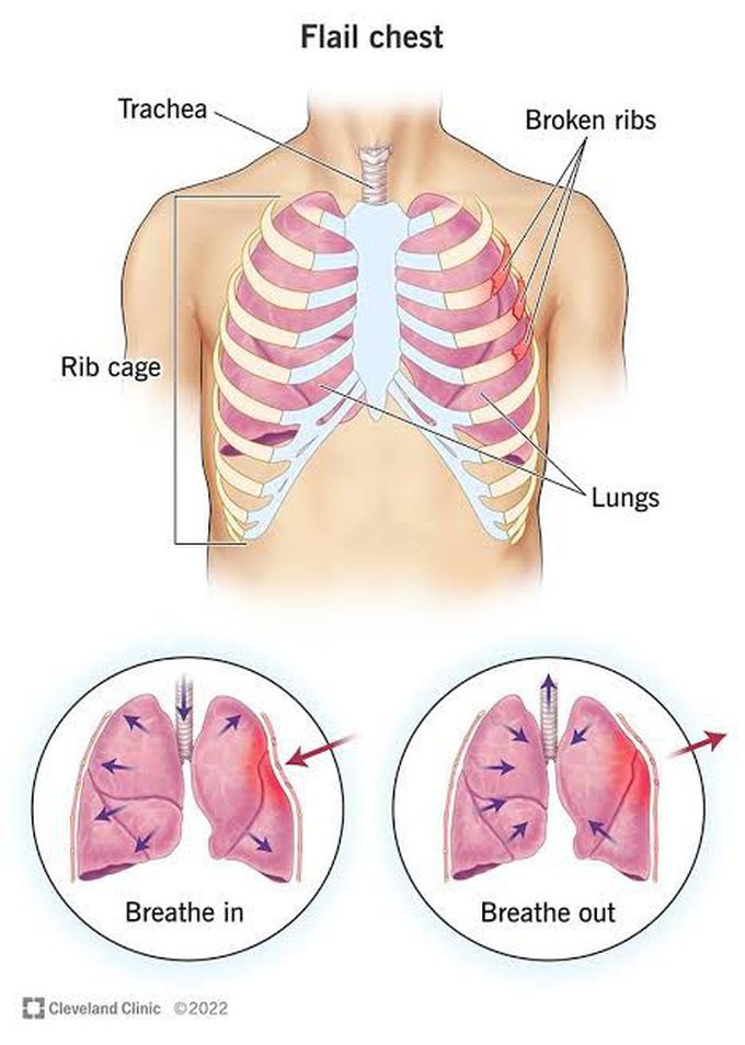 Flail chest management