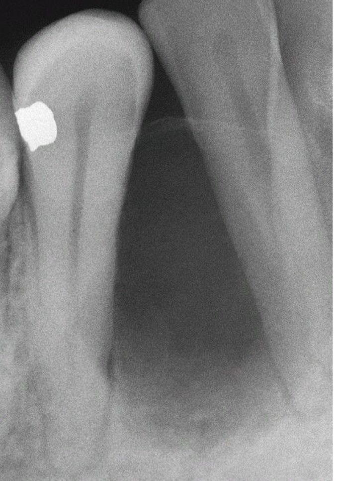 Odontogenic Myxoma