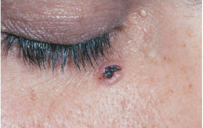 Nevoid Basal Cell Carcinoma Syndrome