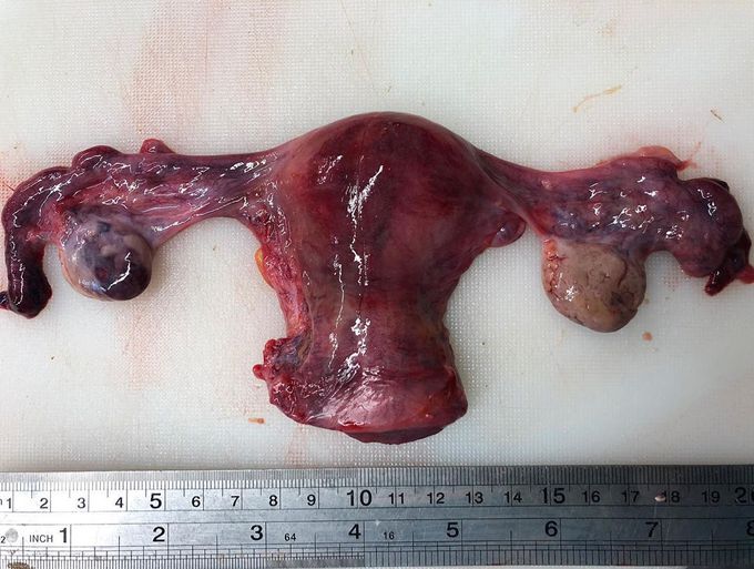 Removed uterus along with its fallopian tubes and ovaries