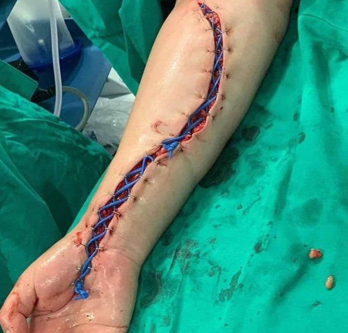 Surgical repair of compartment syndrome