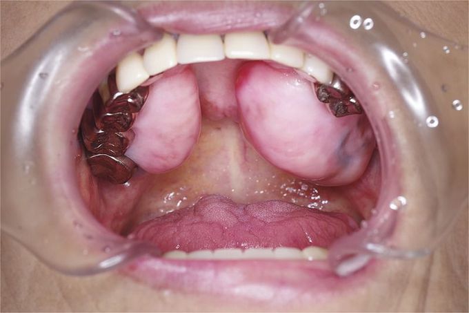Oral Maxillary Exostosis