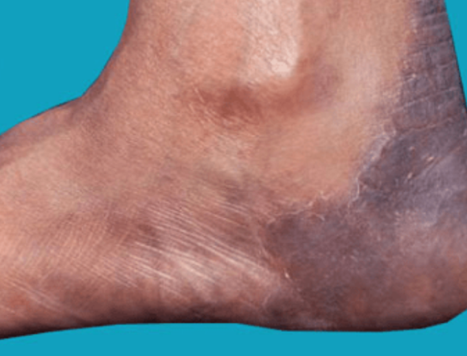 Athlete's foot (tinea pedis)