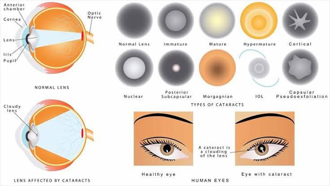 Different Types of Cataract