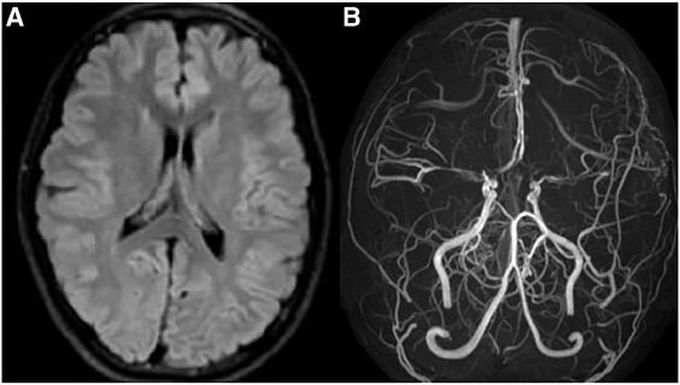 Moyamoya Disease