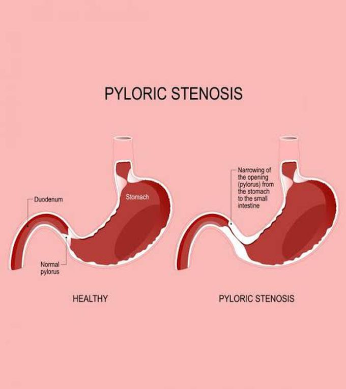 pyloric stenosis shoulder sign