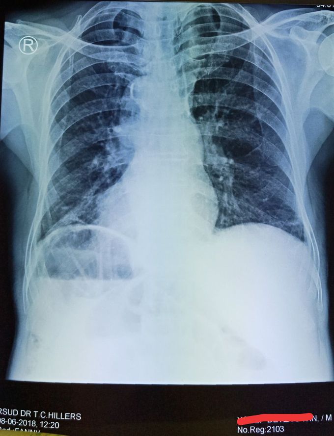 DEXTROCARDIA with SITUS INVERSUS