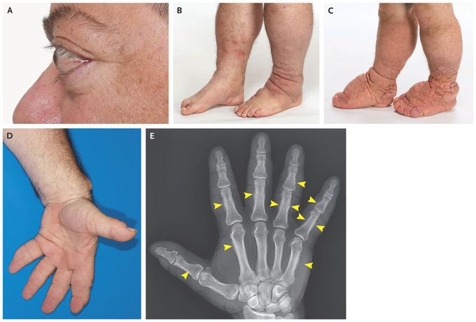 Thyroid Ophthalmopathy, Dermopathy, and Acropachy