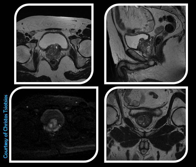 Multiparametric prostate MRI