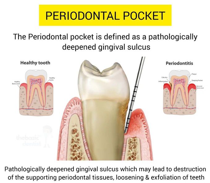 Periodontal Pocket
