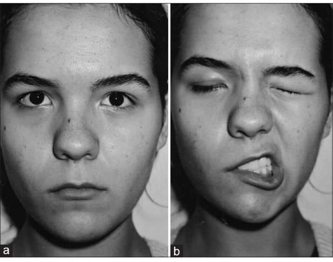 Facial nerve paralysis after dental procedure