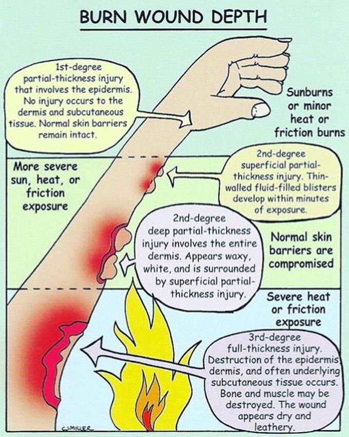 Burn wound depth !