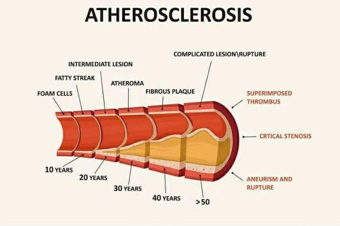 Atherosclerosis