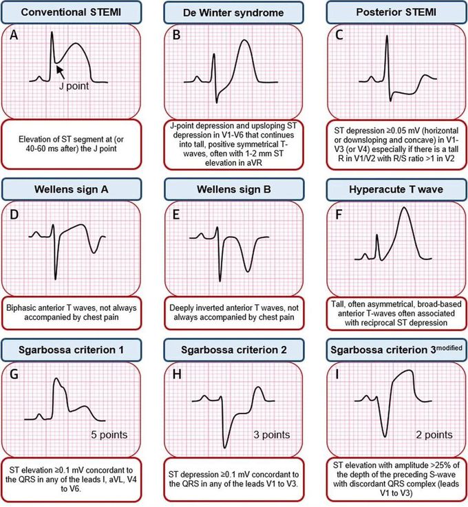 ECG Rhythms