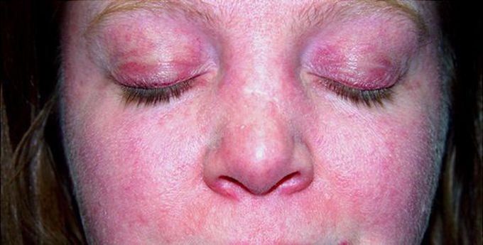 Clinical Thinking #4. #ItsNeverLupus