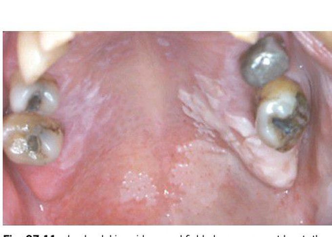 Leukoplakia