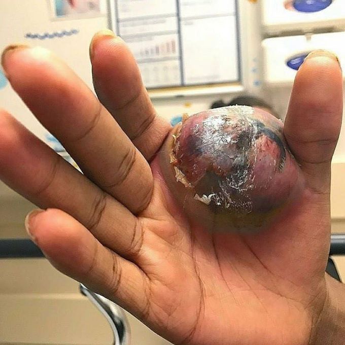 Ecthyma gangrenosum