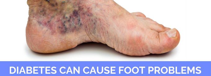 Cause of Diabetic foot