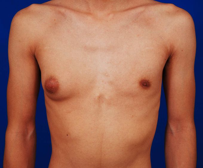 Unilateral Gynecomastia