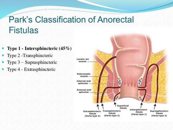Anorectal Fistulas