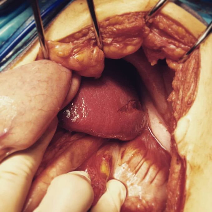 Ruptured spleen