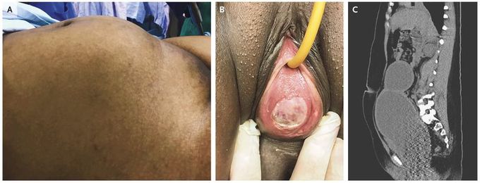 Hematometrocolpos in a Teenager