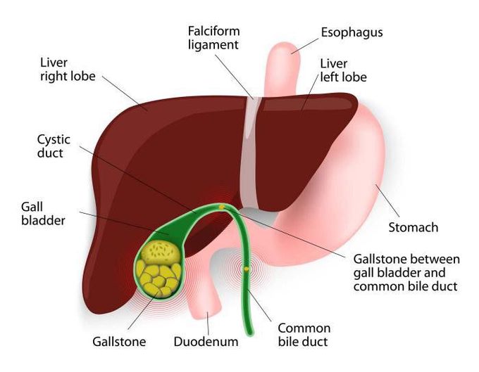 Cholecystitis is a swelling and irritation of your gallbladder, a small organ in the right side of your belly near your liver.

The gallbladder’s job is to hold a digestive juice called bile. It releases bile into your small intestine when your body needs it to break down fats. But if the path to your small intestine is blocked, bile gets trapped. That backup can irritate your gallbladder. That’s how cholecystitis happens.

Nausea and vomiting are common symptoms. They often show up after you’ve eaten a big or especially fatty meal.


It’s easy to mistake cholecystitis for other health problems, but another telltale sign is intense pain -- in your belly, in your back, or under your right shoulder blade.

If you don’t see a doctor and get treatment, it can lead to dangerous infections or become a long-term condition. The most common solution is surgery to remove your gallbladder.