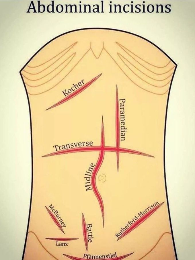 Abdominal Incisions