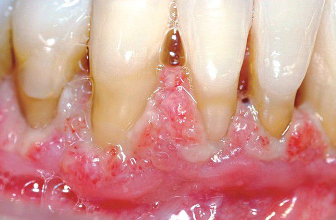 Plasminogen Deficiency.