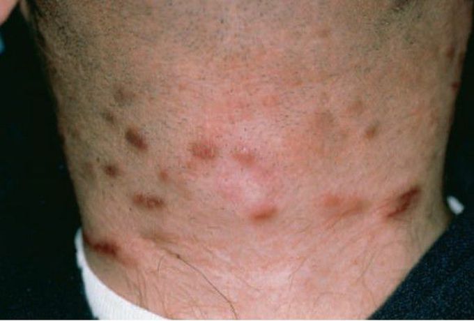 Kaposi sarcoma of neck