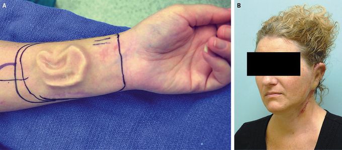 Prelaminated Free Flap for Auricular Reconstruction