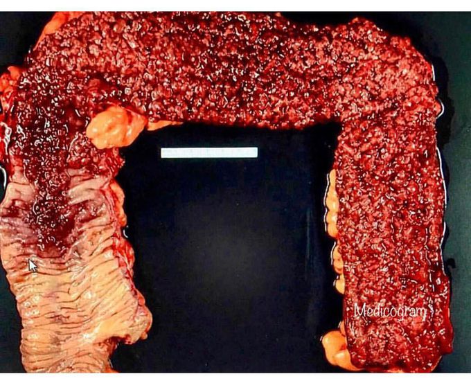 Ulcerative colitis