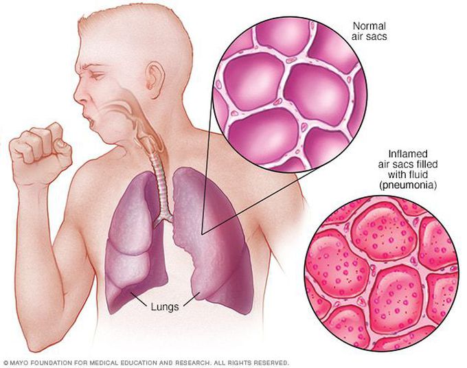 Risk factos of pneumonia