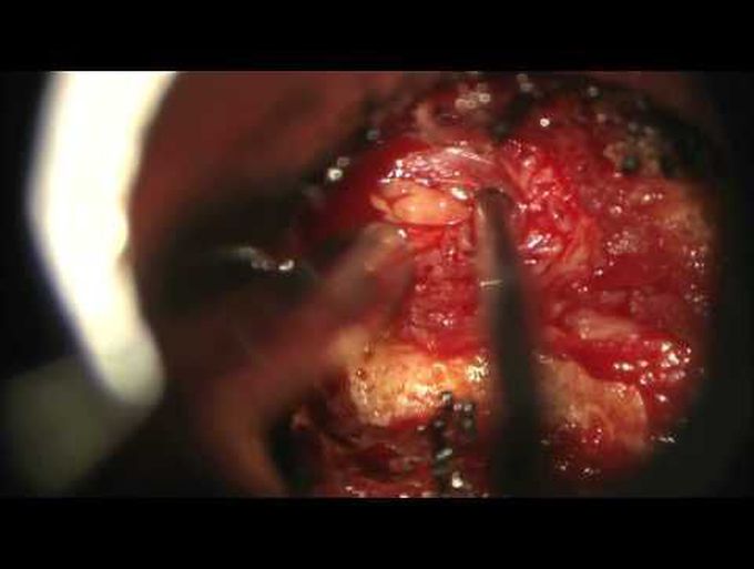Minimally invasive surgery for lumbar microdiscectomy