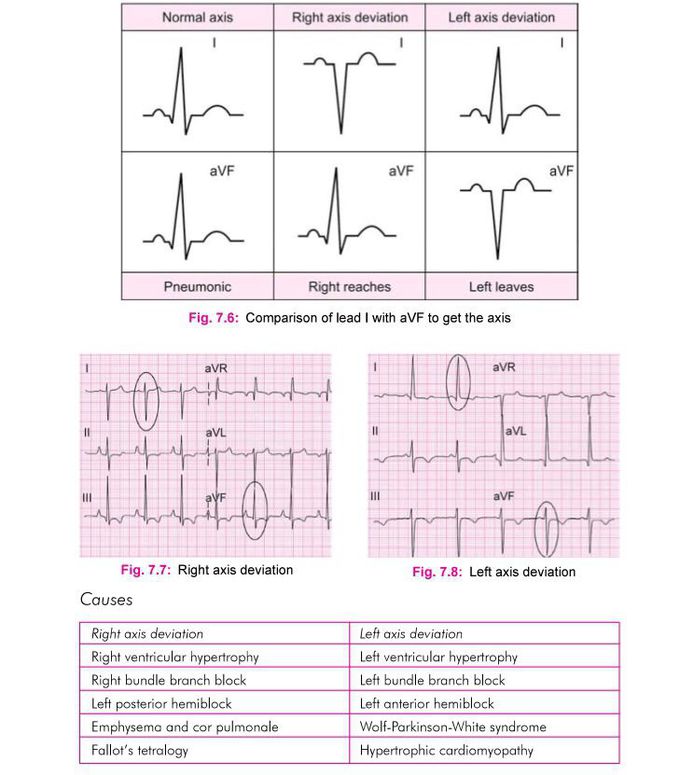 How to determine the axis of ECG ?