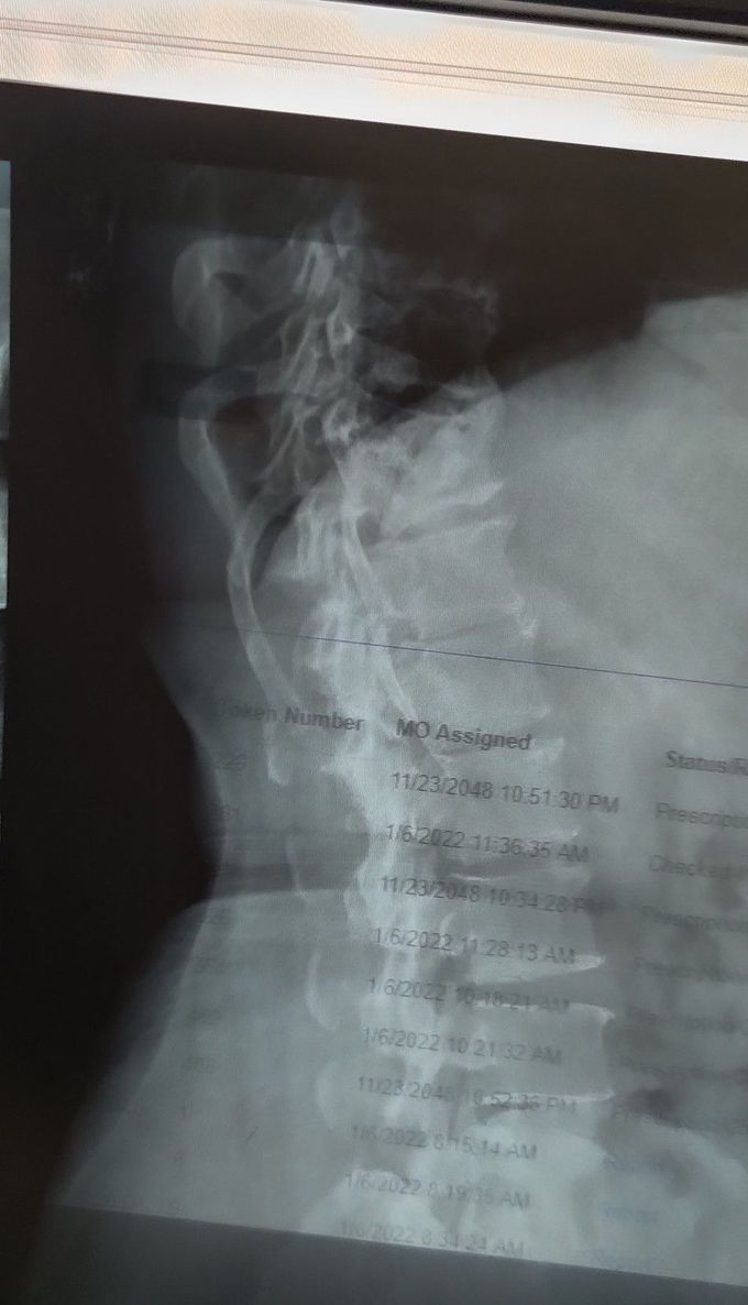 Osteoporosis + Osteophytes + Vertebral Fracture