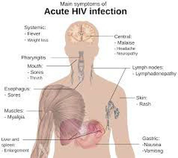 Acute HIV infection