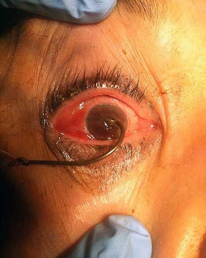 Eye injury sustained while fishing from a fishing hook! 