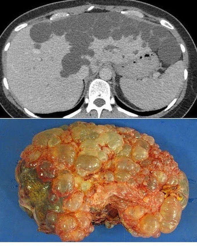 Polycystic Liver Disease