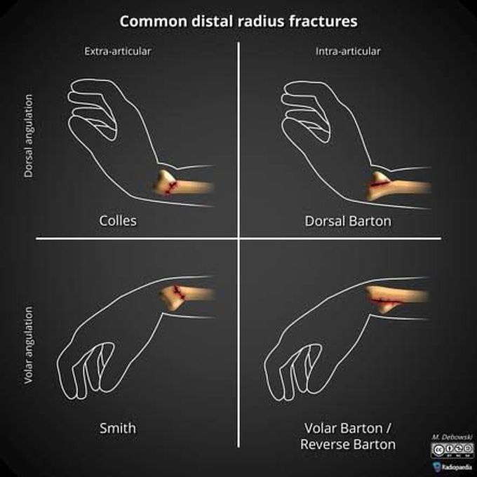 Common Distal Radius Fracture