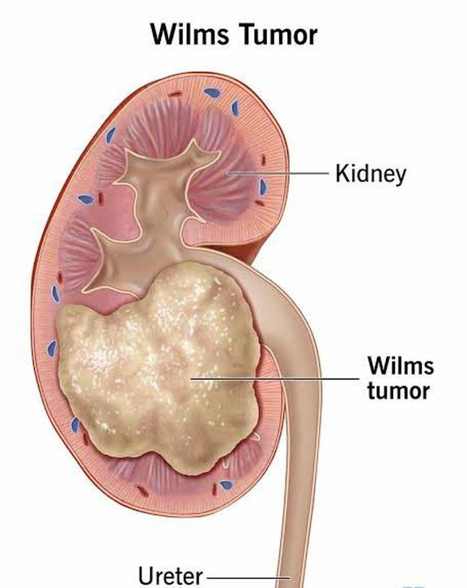 Causes of wilms tumor