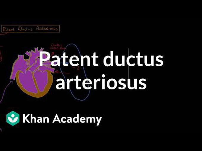 Patent Ductus Arteriosus