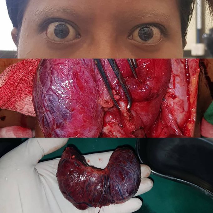 Surgery in hyperthyroid 