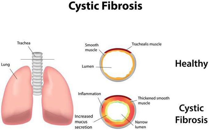 Cystic fibrosis