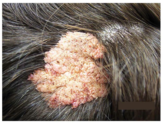 Nevus Sebaceus of Jadassohn