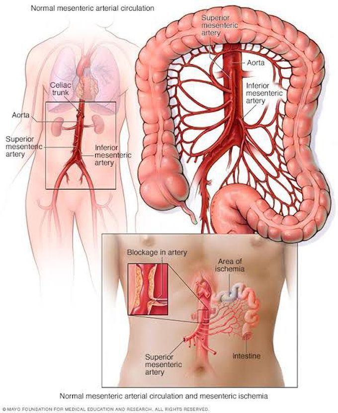 Causes of mesentric ischemia