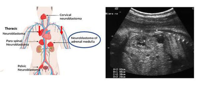 Neuroblastoma MEDizzy