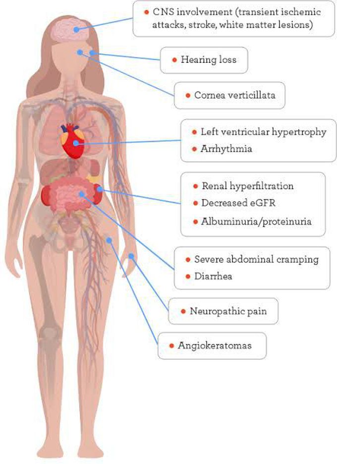 Fabrys disease