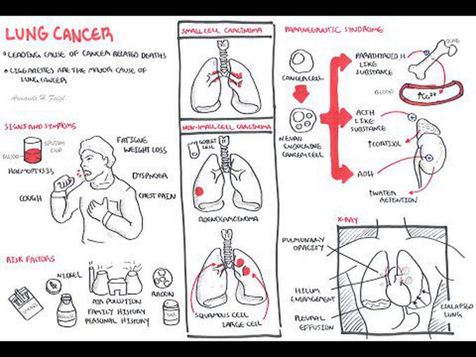 Short introduction of Lung cancer