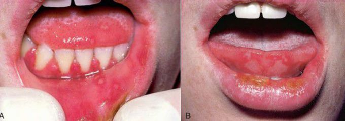 Primary herpes simplex infection
